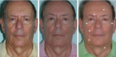 man before and after Anti Aging Treatments